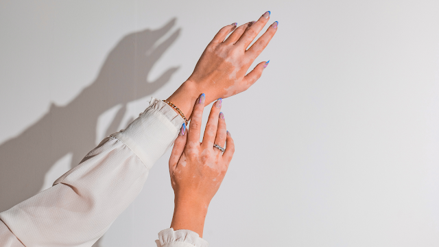 Mãos femininas com vitiligo, exibindo manchas de despigmentação na pele, com unhas pintadas e acessórios elegantes, sob luz suave.